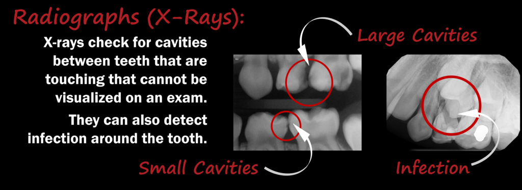Radiographs can detect small cavities before they become larger, and more difficult to treat.